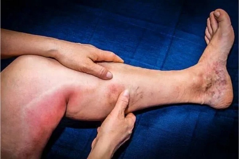 Minh họa lưu thông máu ở chân khi ngồi lâu trên máy bay